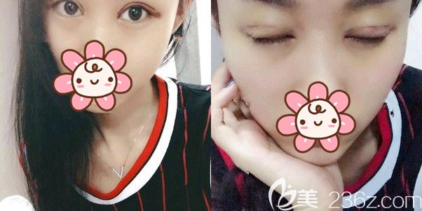 一周拆線眼睛恢復(fù)狀態(tài)