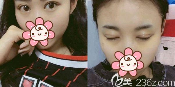 術(shù)后20多天眼睛腫脹基本消失