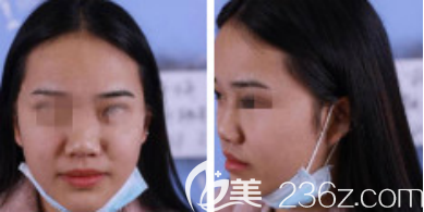 術(shù)前 術(shù)前