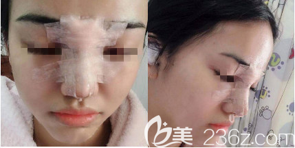 術(shù)后第三天 術(shù)后第三天