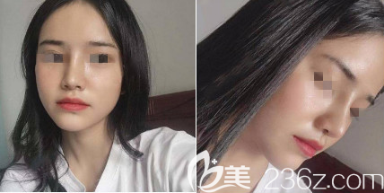 術(shù)后30天 術(shù)后30天