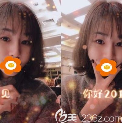 在福州比華利讓林平醫(yī)生做了自體肋軟骨綜合隆鼻后拯救了我的塌鼻梁