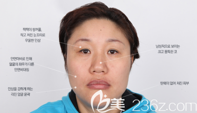 術(shù)前面部照片 術(shù)前面部照片