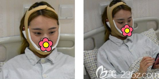 蘭州時光逯巖面部吸脂第2天效果