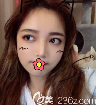 面部吸脂做完10天圖片