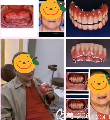 南京美奧口腔門診部馬建民術(shù)前照片1