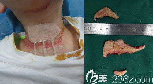 武漢正璞疤痕去除手術(shù)后當(dāng)天