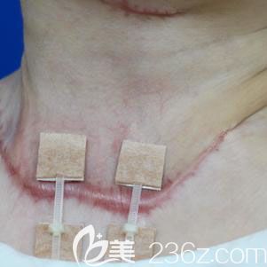 武漢去疤痕哪家醫(yī)院好？正璞疤痕整復(fù)祛疤案例