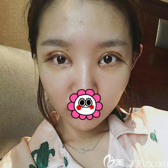 雙眼皮術(shù)后恢復(fù)三天