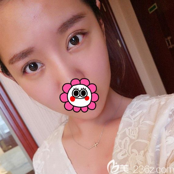 雙眼皮術(shù)后半個月<span style=