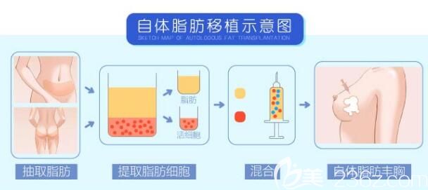 自體脂肪豐胸原理示意圖