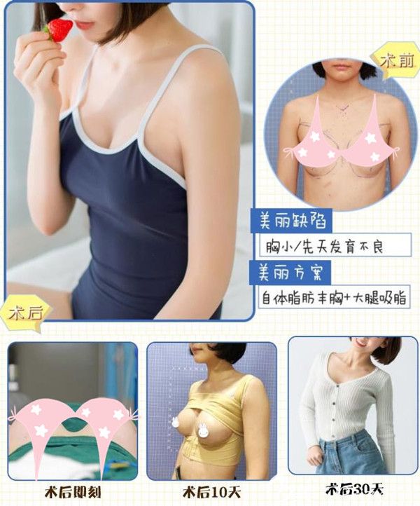 在蘇州康美做過自體脂肪豐胸前后對(duì)比
