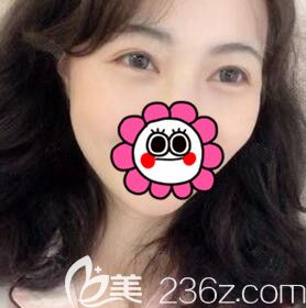 在雅美割雙眼皮術(shù)后2個(gè)月效果