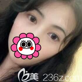 找衡陽雅美醫(yī)療美容醫(yī)院廖偉龍做雙眼皮整形術后3個月恢復效果圖分享！