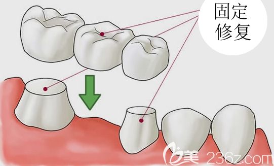 馬丹軍科普可摘活動(dòng)義齒和固定義齒哪個(gè)好 馬丹軍科普可摘活動(dòng)義齒和固定義齒哪個(gè)好