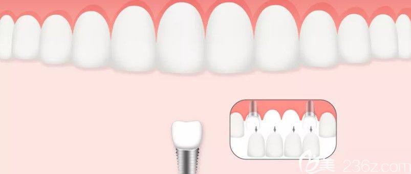 上下頜骨條件不好的顧客是可以做種植牙的
