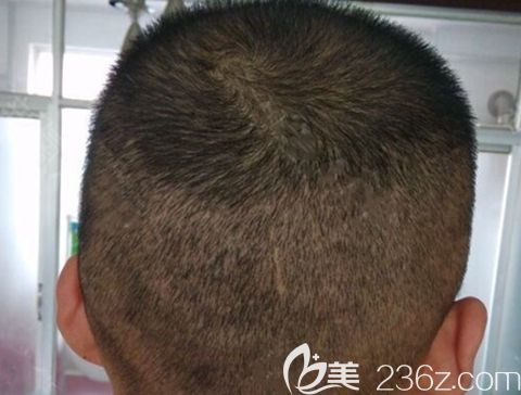 植發(fā)后取發(fā)區(qū)恢復(fù)圖片