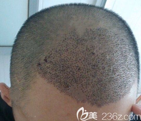 廣州碧蓮盛術(shù)后5天