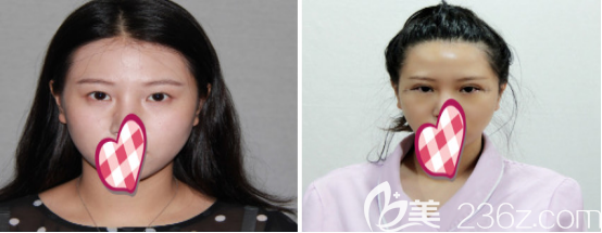 術(shù)前 術(shù)前