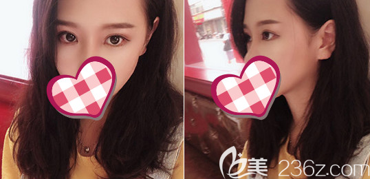 術(shù)后15天 術(shù)后15天