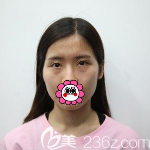 做自體脂肪面部填充前 做自體脂肪面部填充前