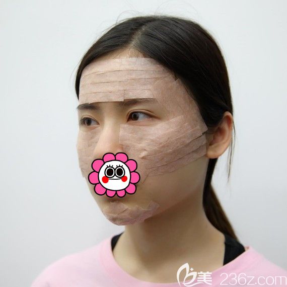 自體脂肪填充全臉術(shù)后即刻 自體脂肪填充全臉術(shù)后即刻