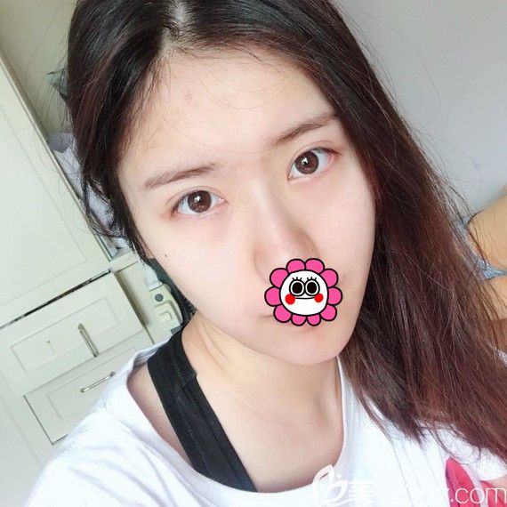 自體脂肪填充全臉術(shù)后五天 自體脂肪填充全臉術(shù)后五天