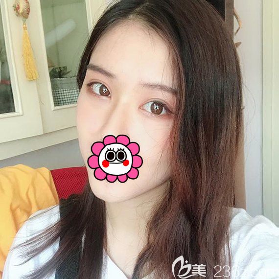 分享我找寧波靜港林忠泵做的脂肪填充全臉效果來打消自體脂肪填充后悔的疑慮