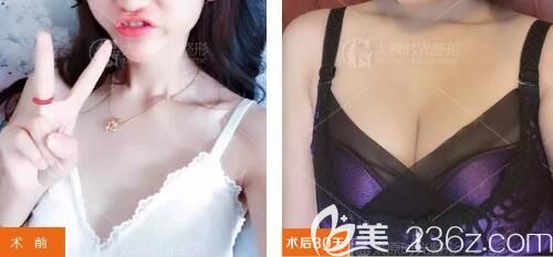 術前空杯絕望，術后望杯興嘆，兩者的差距只是因為在太原時光植入了300cc假體隆胸