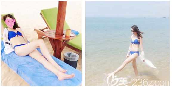 親自找中信惠州醫(yī)院整形科陳虹做完大腿吸脂后才知道惠州吸脂醫(yī)院哪家好