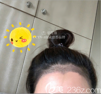 賀俊美人尖發(fā)際線種植一周效果 賀俊美人尖發(fā)際線種植一周效果