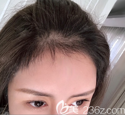 深圳碧蓮盛賀俊發(fā)際線調(diào)整術(shù)后3個月 深圳碧蓮盛賀俊發(fā)際線調(diào)整術(shù)后3個月