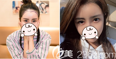 深圳碧蓮盛賀俊植發(fā)際線一年對比照片 深圳碧蓮盛賀俊植發(fā)際線一年對比照片