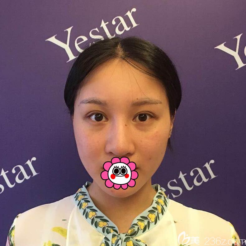 到寧波藝星做鼻綜合前 到寧波藝星做鼻綜合前