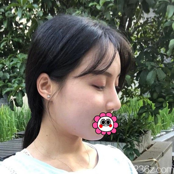 寧波藝星鼻綜合效果怎么樣 寧波藝星鼻綜合效果怎么樣