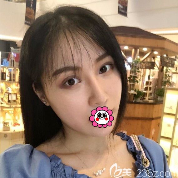 在寧波藝星找肖慶華做肋軟骨綜合隆鼻恢復(fù)兩個(gè)月后面部更加協(xié)調(diào)了