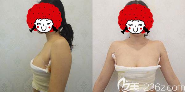 曼托毛面假體術(shù)后四天換藥 曼托毛面假體術(shù)后四天換藥