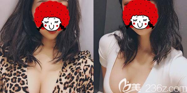 對比過250和275假體大小后，我在南京美貝爾醫(yī)生建議下做了美國進(jìn)口曼托毛面假體降低包膜攣縮概率