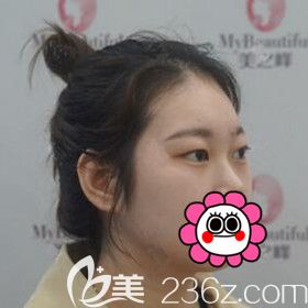 在長沙美之峰做雙眼皮術前照 在長沙美之峰做雙眼皮術前照