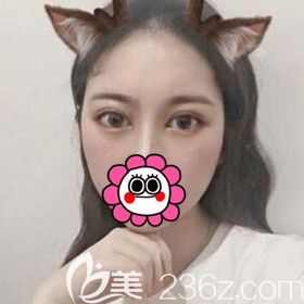 割雙眼皮術后4天效果圖 割雙眼皮術后4天效果圖