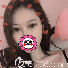 割雙眼皮術后10天效果圖 割雙眼皮術后10天效果圖