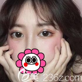 在長沙美之峰割雙眼皮術后15天效果圖 在長沙美之峰割雙眼皮術后15天效果圖