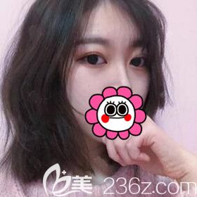 快看我找長沙美之峰劉磊做的切開雙眼皮術(shù)后1個(gè)月恢復(fù)效果還不錯(cuò)吧！