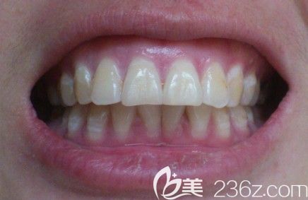 這是深圳格倫菲爾口腔員工戴隱適美牙套矯正齙牙的親身感受,有經(jīng)驗的來評論牙齒矯正好嗎