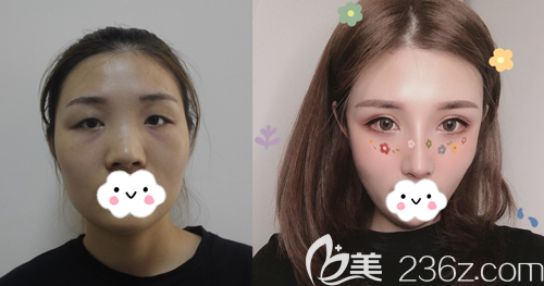 成都市西區(qū)醫(yī)院雙眼皮隆鼻綜合整形效果