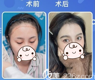 深圳碧蓮盛SHT微針?lè)N植發(fā)際線術(shù)后對(duì)比圖