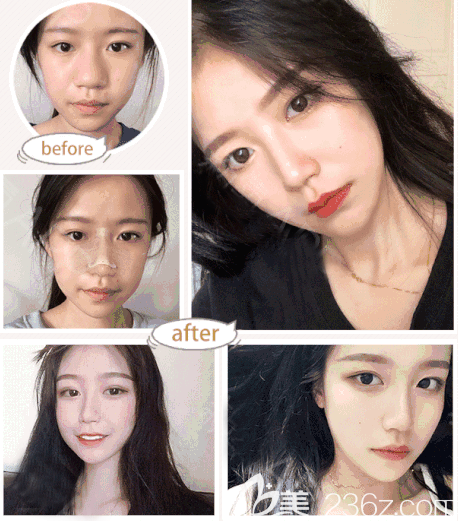 深圳潤澤瑞尼絲李忠醫(yī)生肋軟骨隆鼻案例