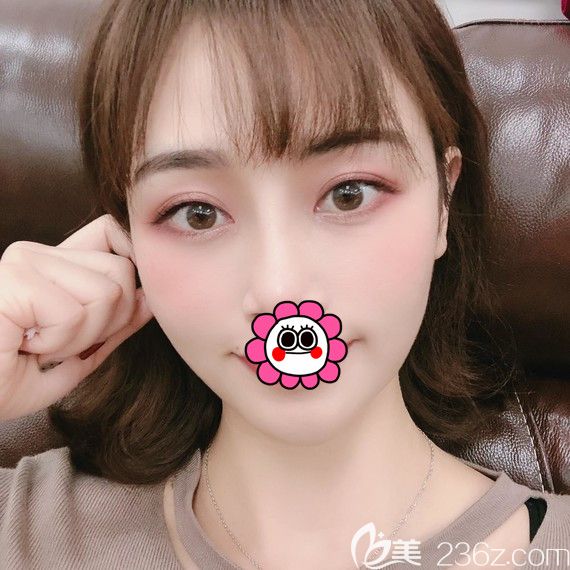 面部凹陷顯老氣找張廣巍醫(yī)生做全臉脂肪填充后臉部飽滿有型還更減齡