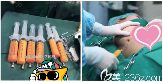 東莞壹加壹王摯隆胸手術(shù)過(guò)程圖