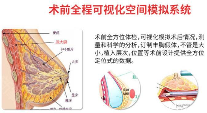 寧波薇琳曾舉隆胸優(yōu)勢